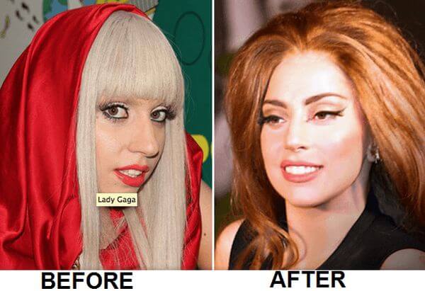Lady Gaga Nose Job
